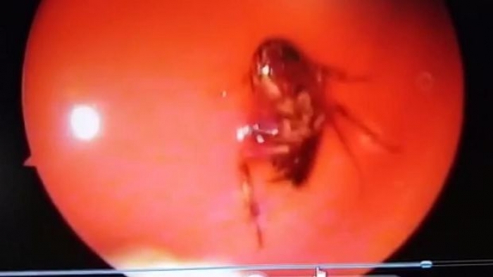Hindistan'da kadının başından diri hamamböceği çıkardılar